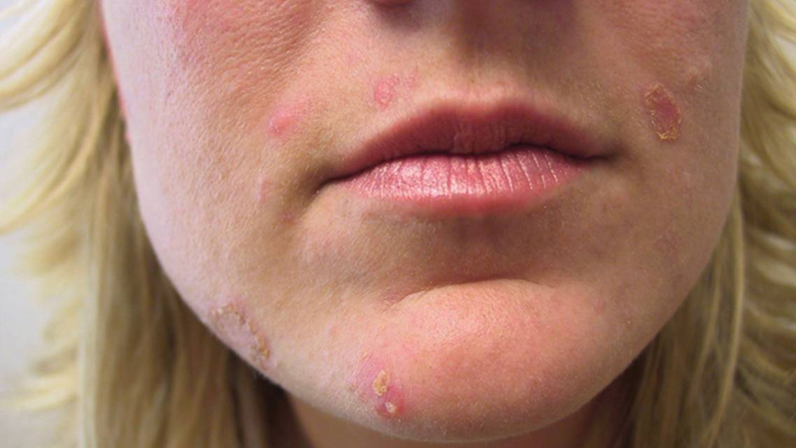 Impetigo
