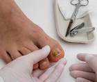 onychomychosis