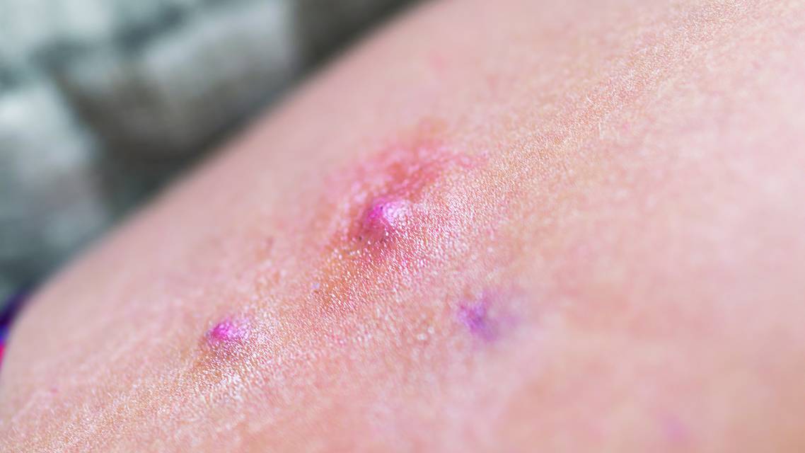 hidradenitis suppurativa