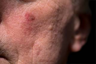 actinic keratosis