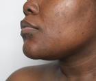hyperpigmentation