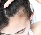 hair loss
