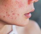 Acne vulgaris