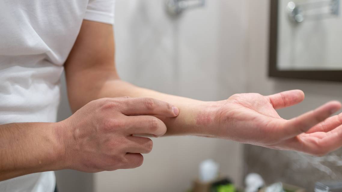 atopic dermatitis
