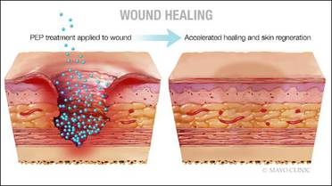 Potential Regenerative Medicine Breakthrough Mayo Clinic Preclinical Discovery Triggers Scarfree Wound Healing image