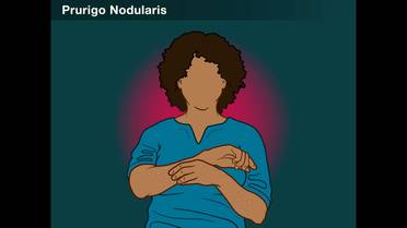 Nemolizumab Shows Continues to Wow in PN image