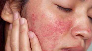 rosacea