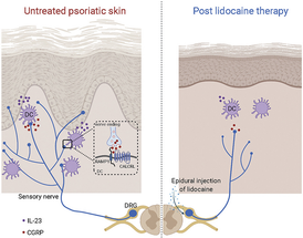 Epidural Nerve Block with Lidocaine Leads to Clearance of Psoriatic Skin Lesions image