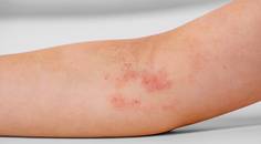 Atopic Dermatitis