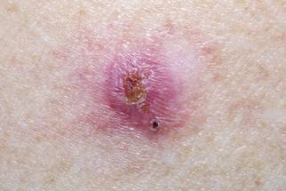 Simple Laser Treatments May Help Prevent Nonmelanoma Skin Cancer image