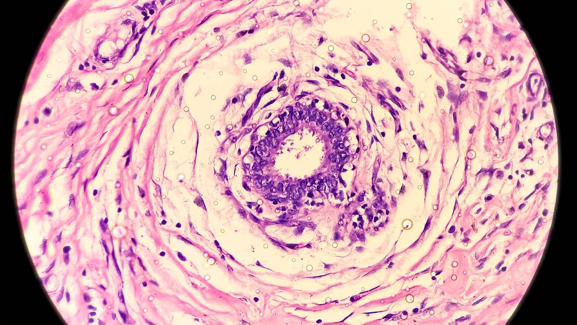 hidradenitis suppurativa