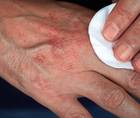 Clinical Insights and Emerging Therapeutic Options for Chronic Hand Eczema