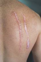 Regenerative Medicine in Action Scars Faded Using Transplanted Hair Follicles image