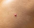 hidradenitis suppurativa
