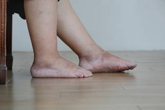 Is Lower Extremity Lymphedema a Risk for Skin Cancer image