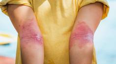 atopic dermatitis topical treatment