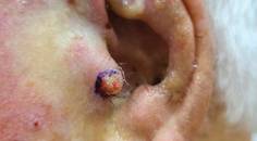 Adnexal Clear Cell Carcinoma with Comedonecrosis