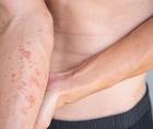 Atopic Dermatitis