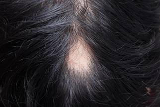 alopecia