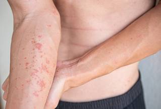 Atopic dermatitis