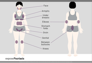 Arcutis Rolls Out New Psoriasis Public Awareness Campaign image