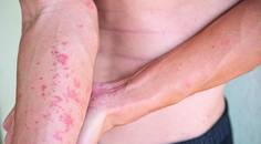 atopic derm