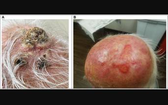 Cetuximab Plus Radiation May Be Effective Treatment for  Advanced Squamous Cell Skin Cancer image