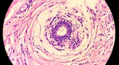 hidradenitis suppurativa