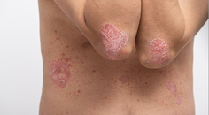 Psoriasis
