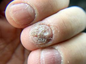 Study Isolated Nail PsO Not Linked to Metabolic Syndrome Risk image