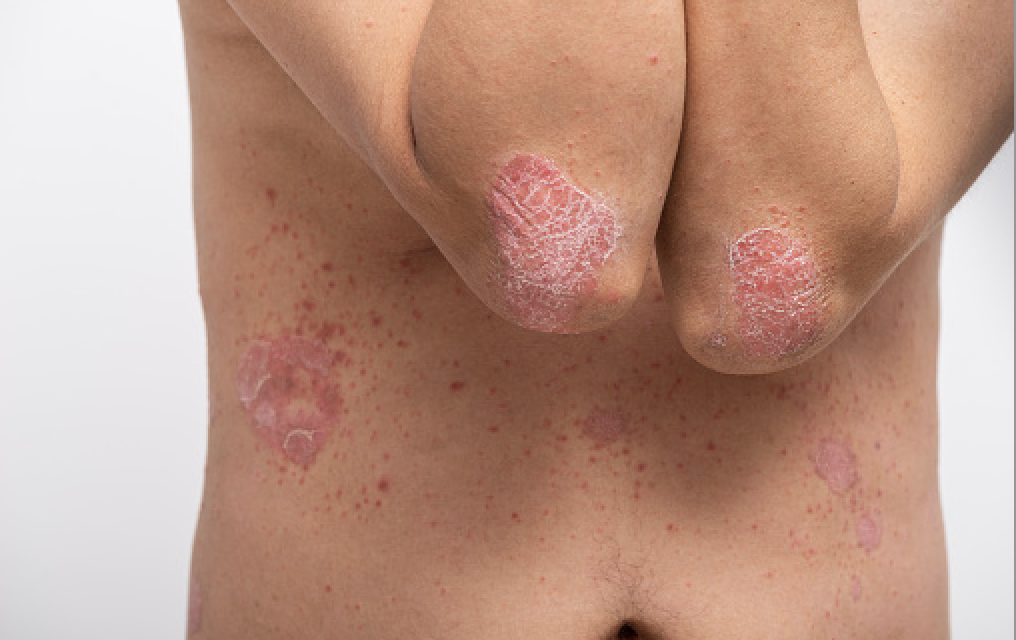 Psoriasis
