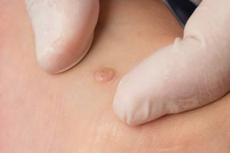 Nielsen BioSciences Maruho Co Ltd Enter License Agreement for the Treatment of Common Warts image