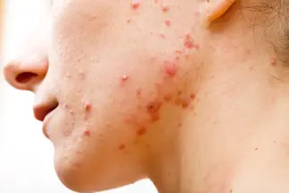 Study Female Adult Acne Patients Face Stigma image