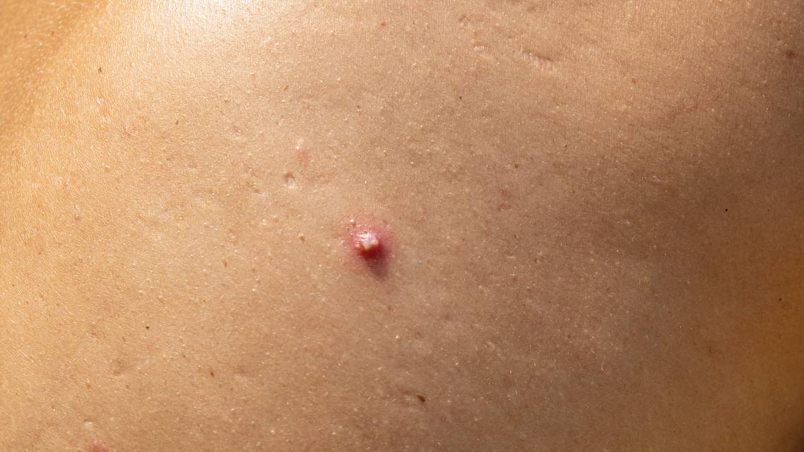 hidradenitis suppurativa