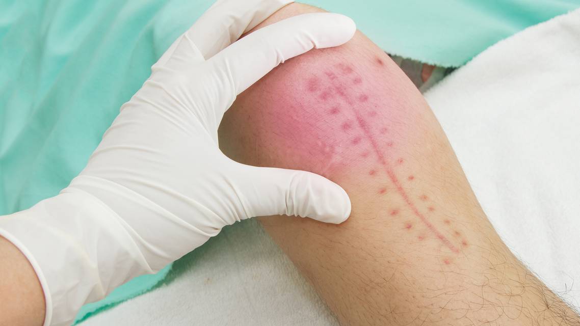 wound healing