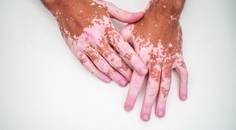 vitiligo