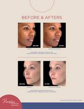 FDA Approves New Cheek Filler from Galderma image