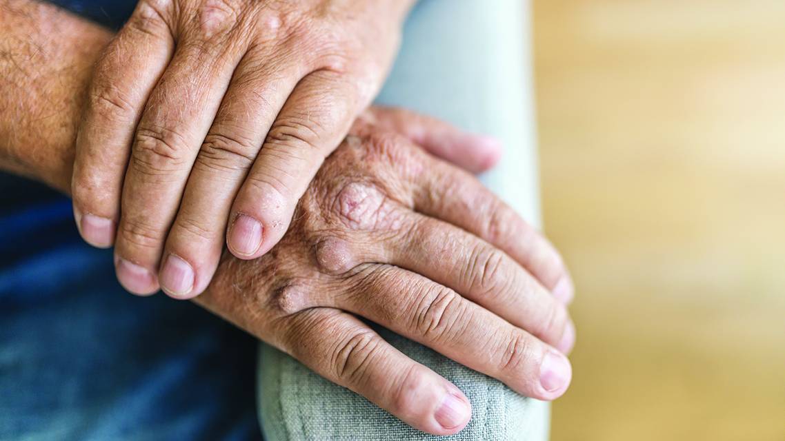 psoriatic arthritis