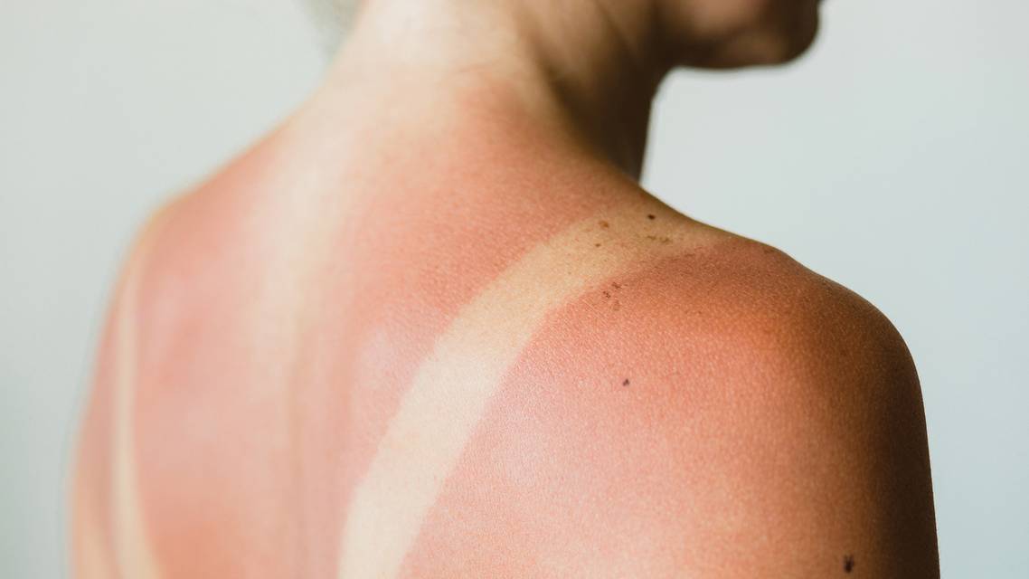 aftersun care