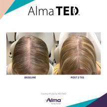 Alma Launches Alma TED CBD Professional Line image