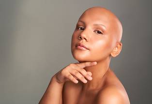 Alopecia