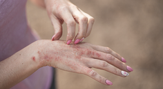 Psoriasis