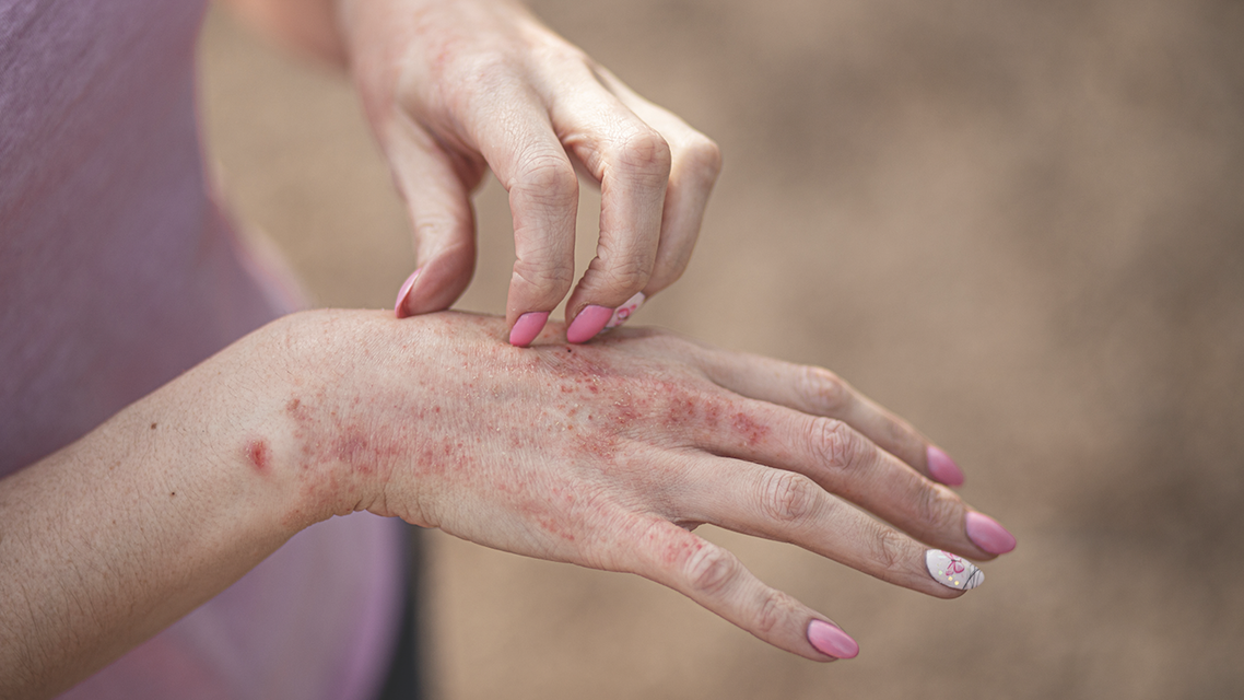 Psoriasis