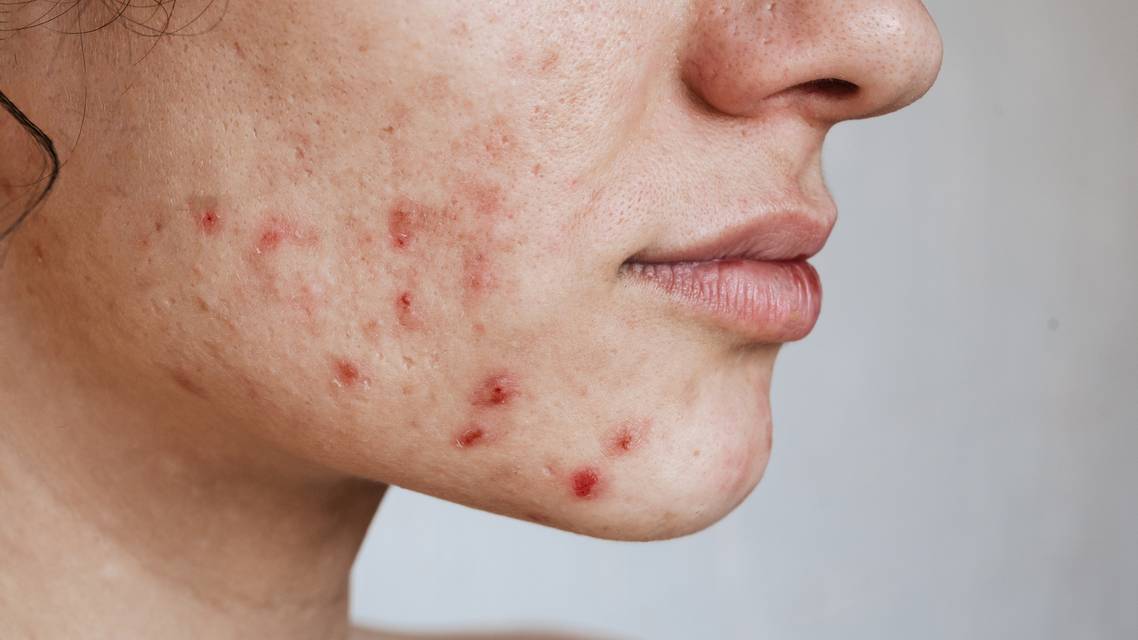 Acne