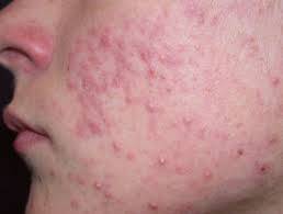 Acne vulgaris