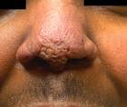 sarcoidosis
