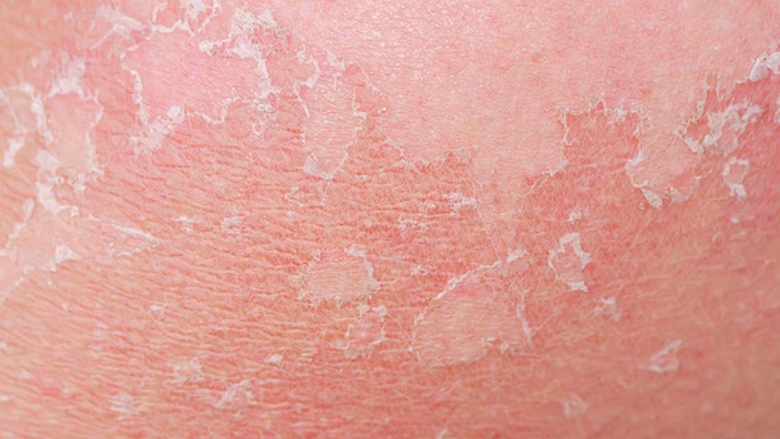 atopic dermatitis