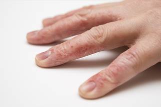 Chronic Hand Eczema