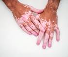vitiligo