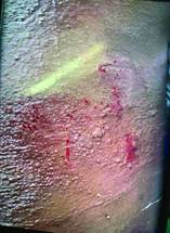 Antibioticinduced Acute Generalized Exanthematous Pustulosis A Case Study of an 18yearold Pregnant Female Presenting with Fev